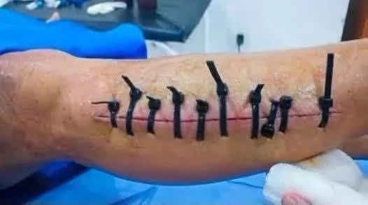 Le cerraron las heridas con cintillos